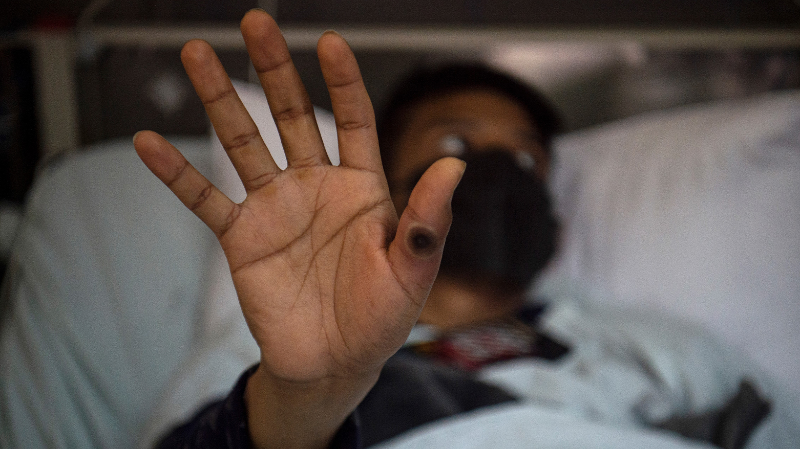 This file photo taken on August 16, 2022 shows a patient showing his hand with a sore caused by an infection of the monkeypox virus. (Photo: AFP)