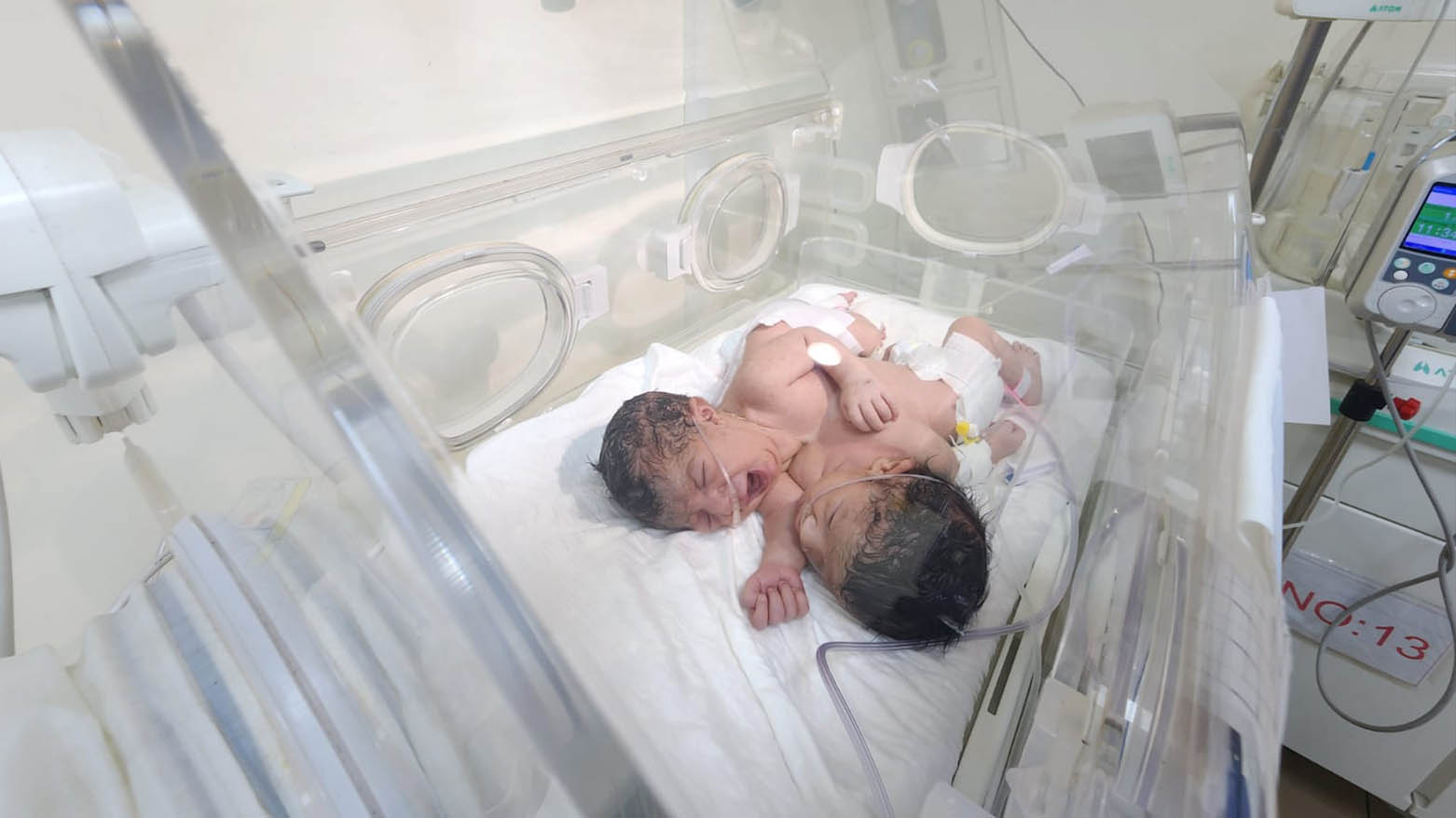 Yapışık ikizler (FOTO-Soran Kameran/ Kurdistan24)