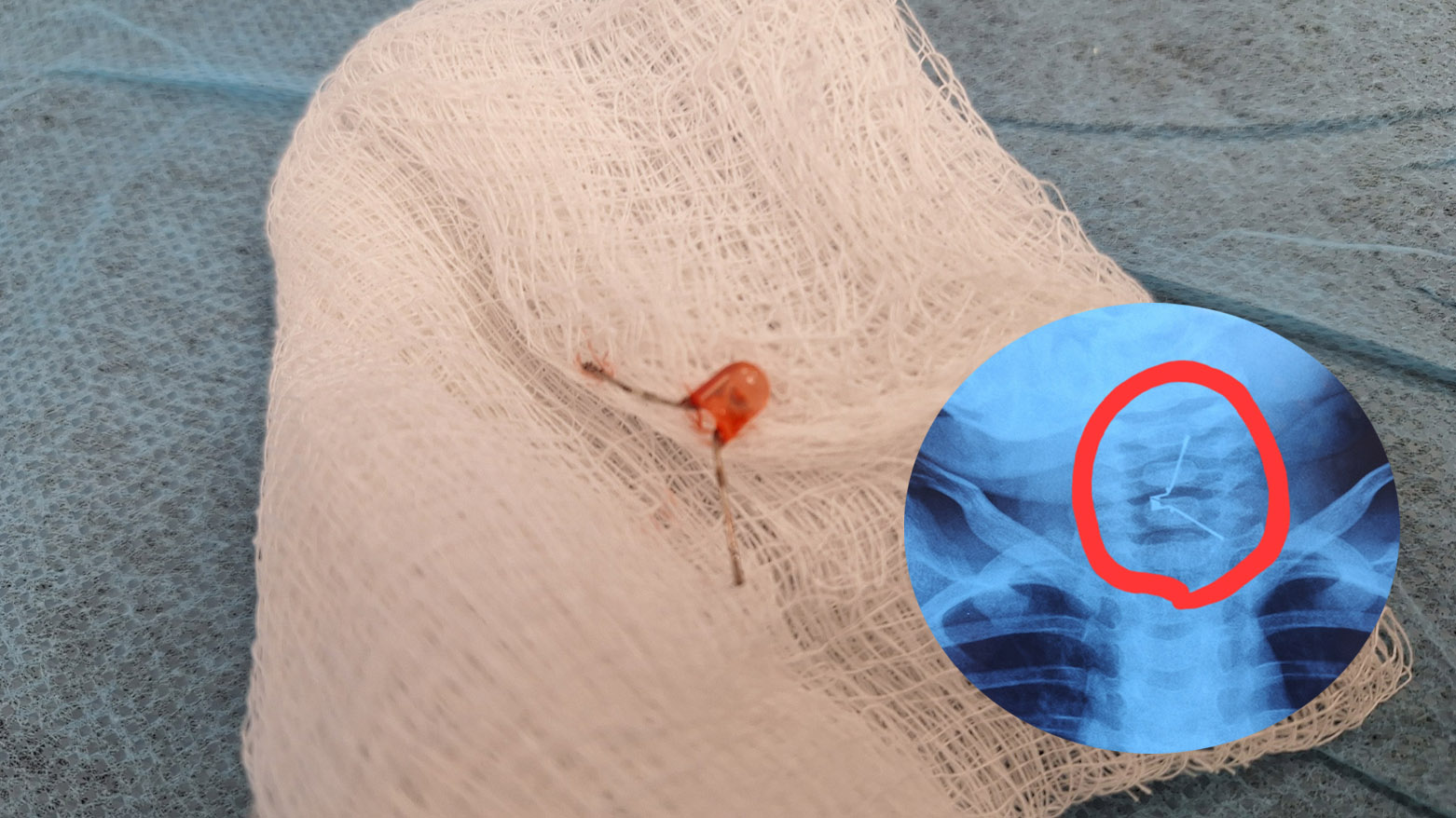 منداڵێک گڵۆپێکی بچووکی قووتدابوو و بە نەشتەرگەریی دەرهێنرا