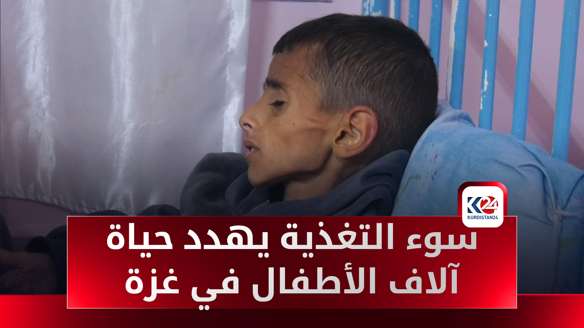 سوء التغذية يهدد حياة آلاف الأطفال في قطاع غزة