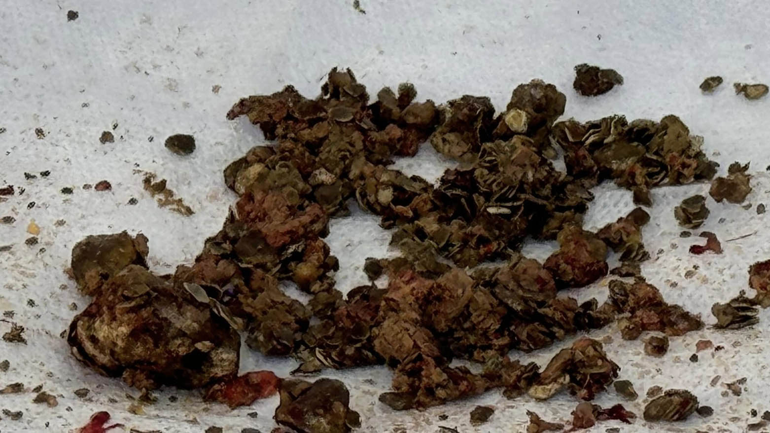 نەشتەرگەریی بۆ ئافرەتێک کراوە مشتێک بەرد لە گورچیلەی دەرهێنراوە
