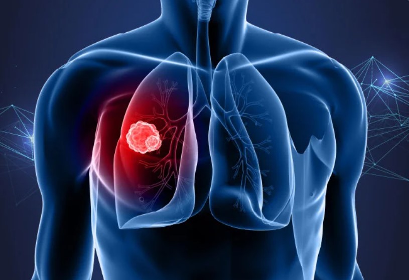 شێرپەنجەی سییەکان؛ساڵانە گیانی نزیکەی 1.8 ملیۆن کەس دەستێنێت