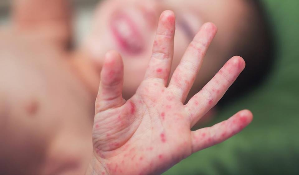 لە مانگێکدا 39 منداڵ لە هەولێر تووشی سوورێژە بوون