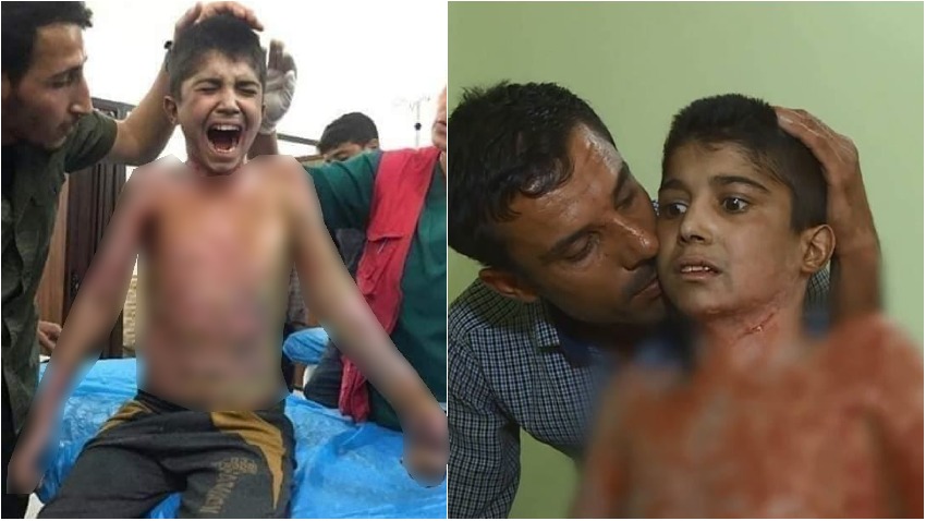 محمد کودک ١٣ ساله کورد که قربانی حمله فسفری ارتش ترکیه به شهر سریکانی غرب کوردستان شد