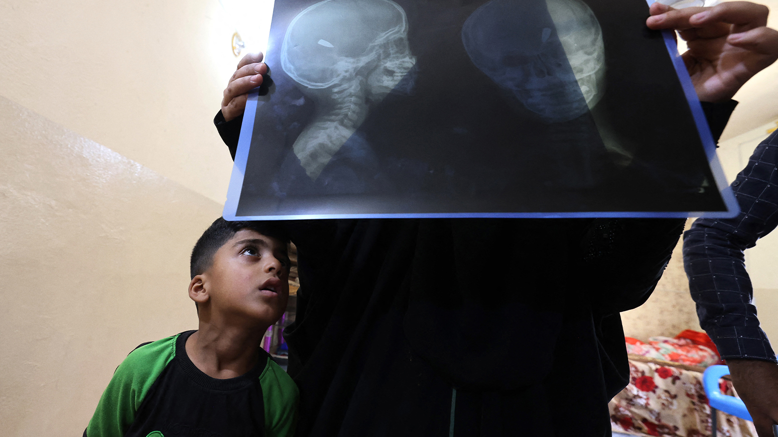 Muhammad Akram, 4-years-old, who was injured by a random gunshot in his home in a village in the Yusufiya not far from Baghdad on May 20, 2024. (Photo: AFP)