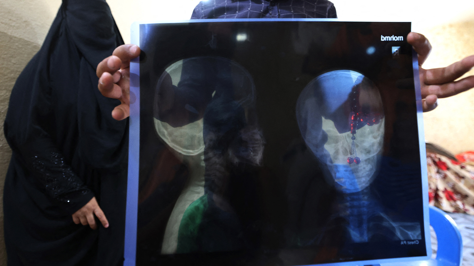 The father holds up the x-ray of Muhammad Akram, 4-years-old, who was injured by a random gunshot in his home in a village in the Yusufiya not far from Baghdad on May 20, 2024. (Photo: AFP)