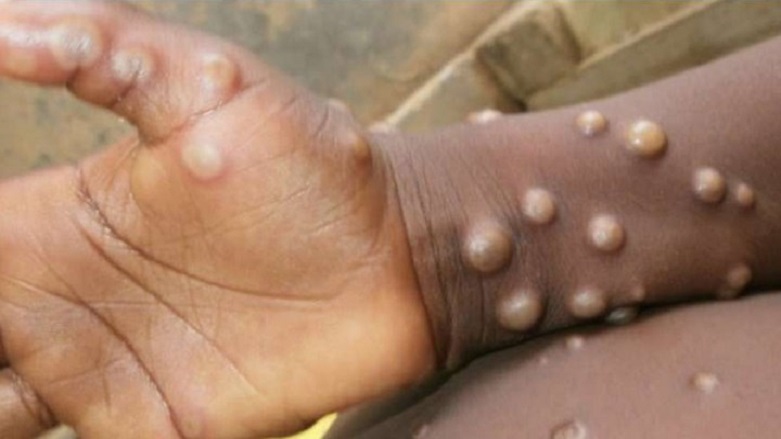 Maymun çiçeği virüsü ABD’ye sıçradı