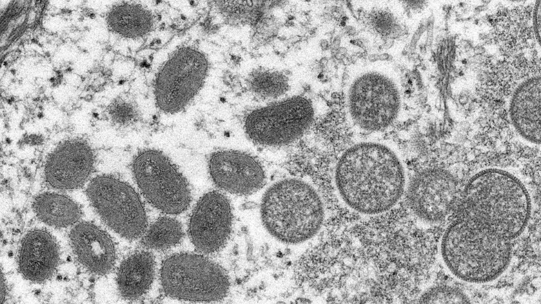 صورة مجهرية إلكترونية (EM) لجزيئات فيروس جدري القرود، عينة سريرية من جلد بشري مرتبطة بتفشي كلاب البراري عام 2003- الصورة لفرانس 24