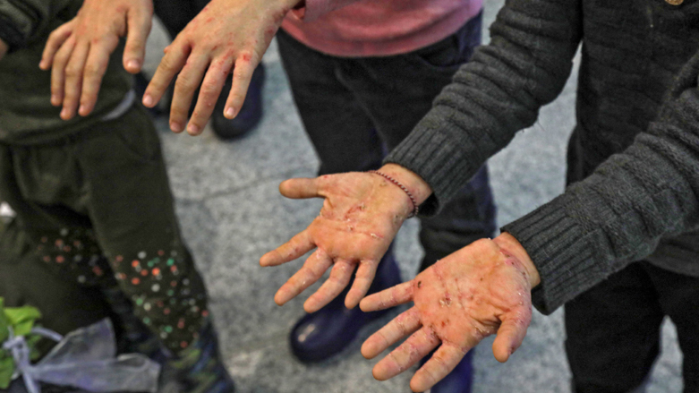 Iraqi migrants who were flown home from the Belarusian capital Minsk, display wounds on their hands from extreme cold sustained while trying to cross into the European Union from Belarus, Nov. 26, 2021. (Photo: Safin Hamed/AFP)