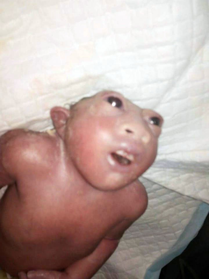 منداڵێكی بێ سەر لە دایك بوو