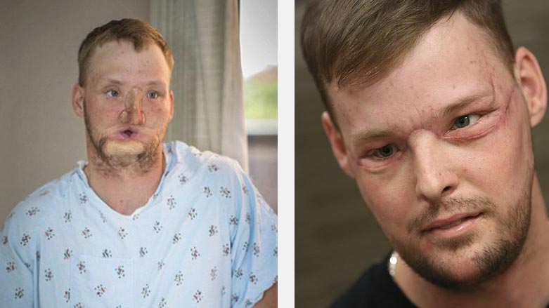 نه‌شته‌رگه‌ری جوانكاری ته‌واوی ژیانی ده‌گۆڕێت
