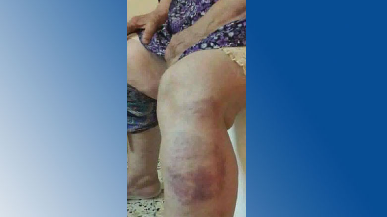 Photos of Shushan's injuries were circulating on Facebook on Sunday.