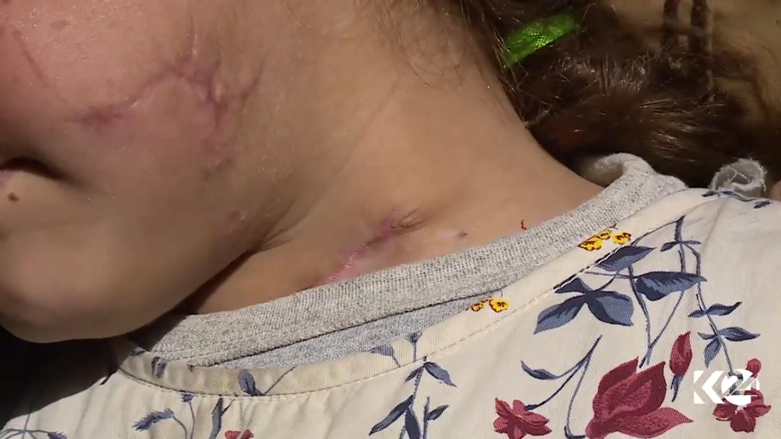 اصيبت دعاء في اجزاء اخرى من جسدها