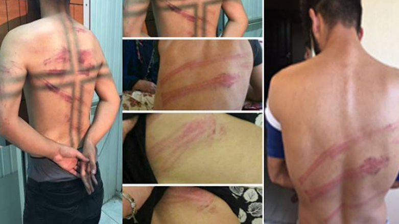 Images show the back of men tortured by Turkish special operations police during a raid on a village in the Semdinli district of the Kurdish province of Hakkari, Aug. 7, 2017. (Photos: DIHABER)