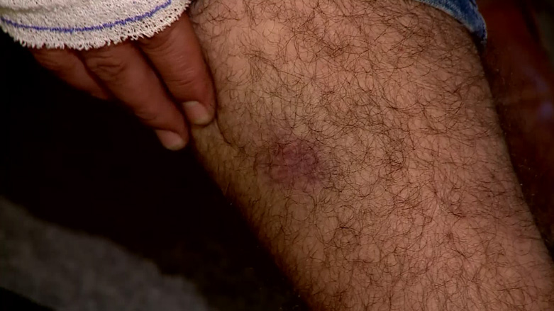 Bruises on Kurdistan 24 cameraman, Nayif Eido Hassan. (Photo: Kurdistan 24)