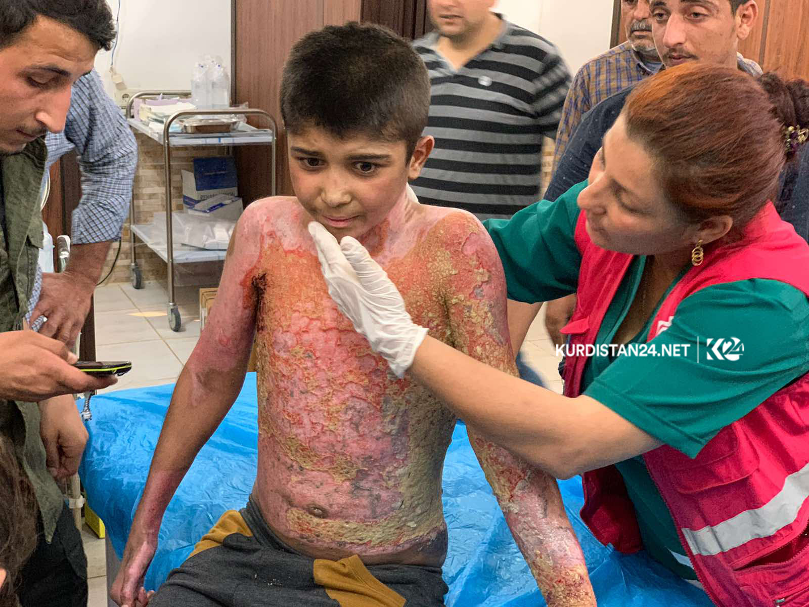 محەمەد حەمید ئەو منداڵەی لە رۆژئاوای كوردستان برینداربوو كە زۆربەی جەستەی سوتاوە - فۆتۆ: ئیسلام یوسف - كوردستان24