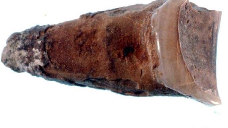 Kadının dişinde mesleği keşfedildi